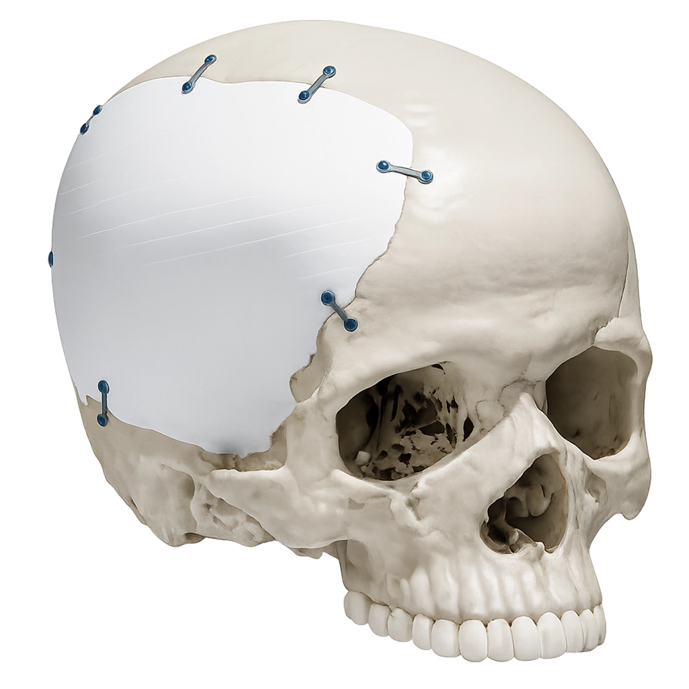 Prótesis Craneales Personalizadas para Neurocirugía Reconstructiva
